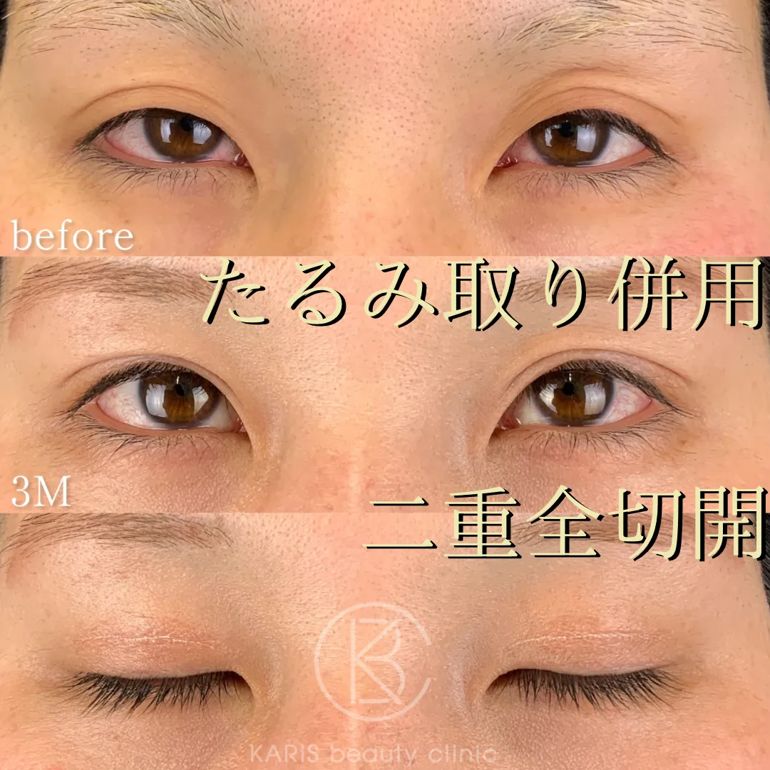 たるみ取り併用全切開