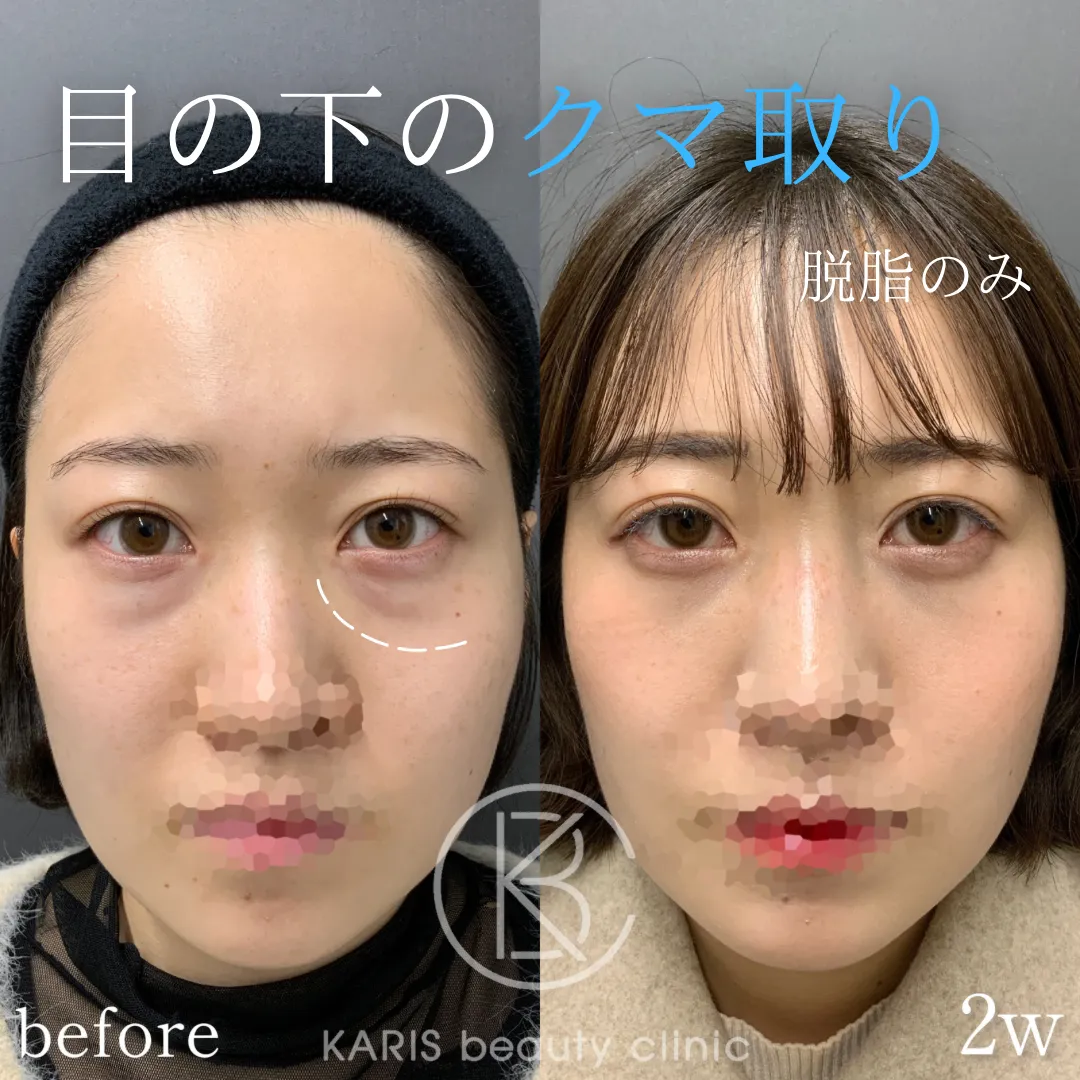 クマ取り（脱脂術）