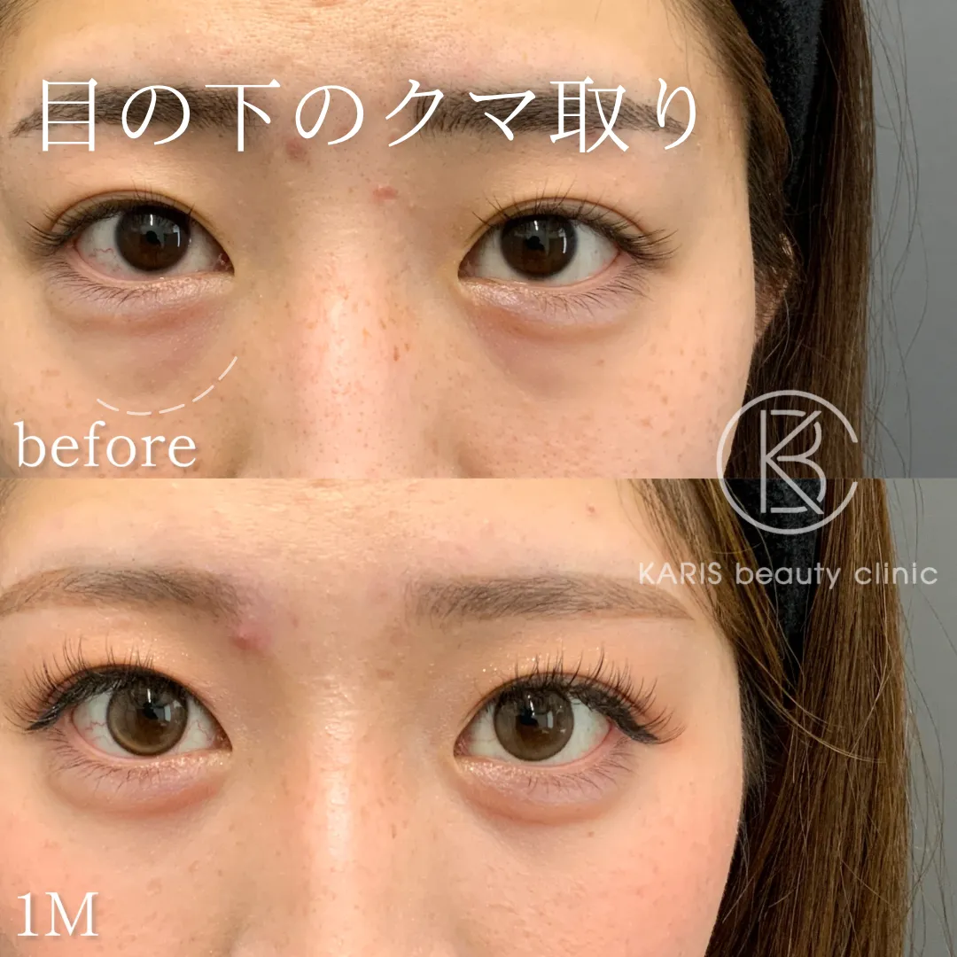 クマ取り（脱脂術）