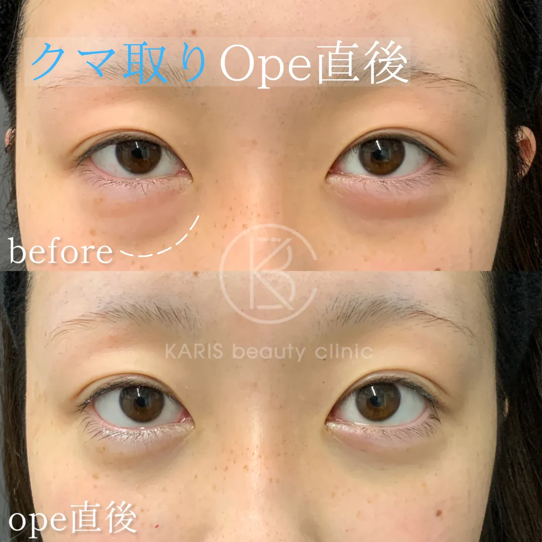 クマ取り（脱脂術）