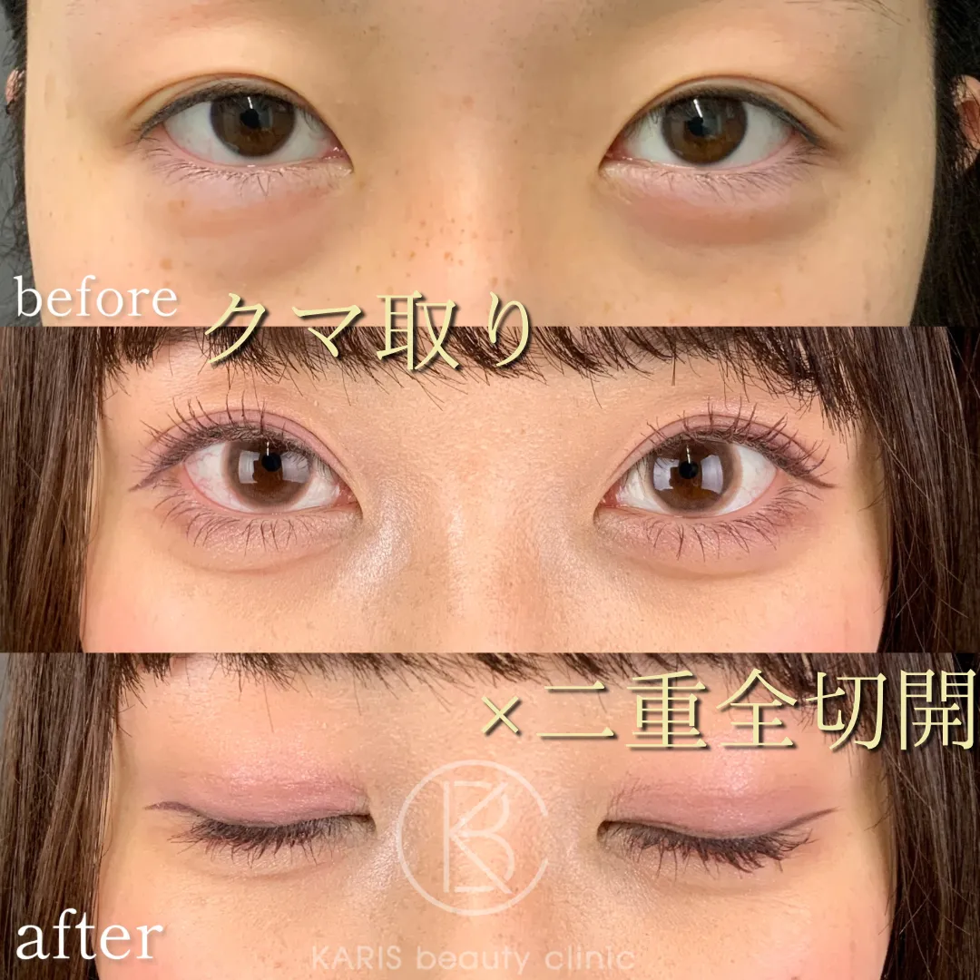 クマ取り（脱脂術）