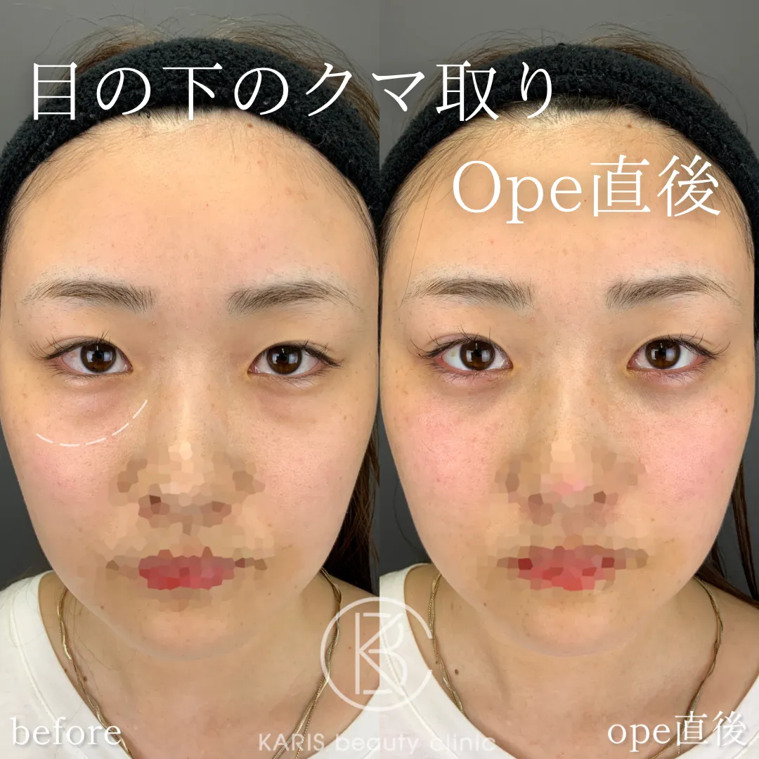 クマ取り（脱脂術）