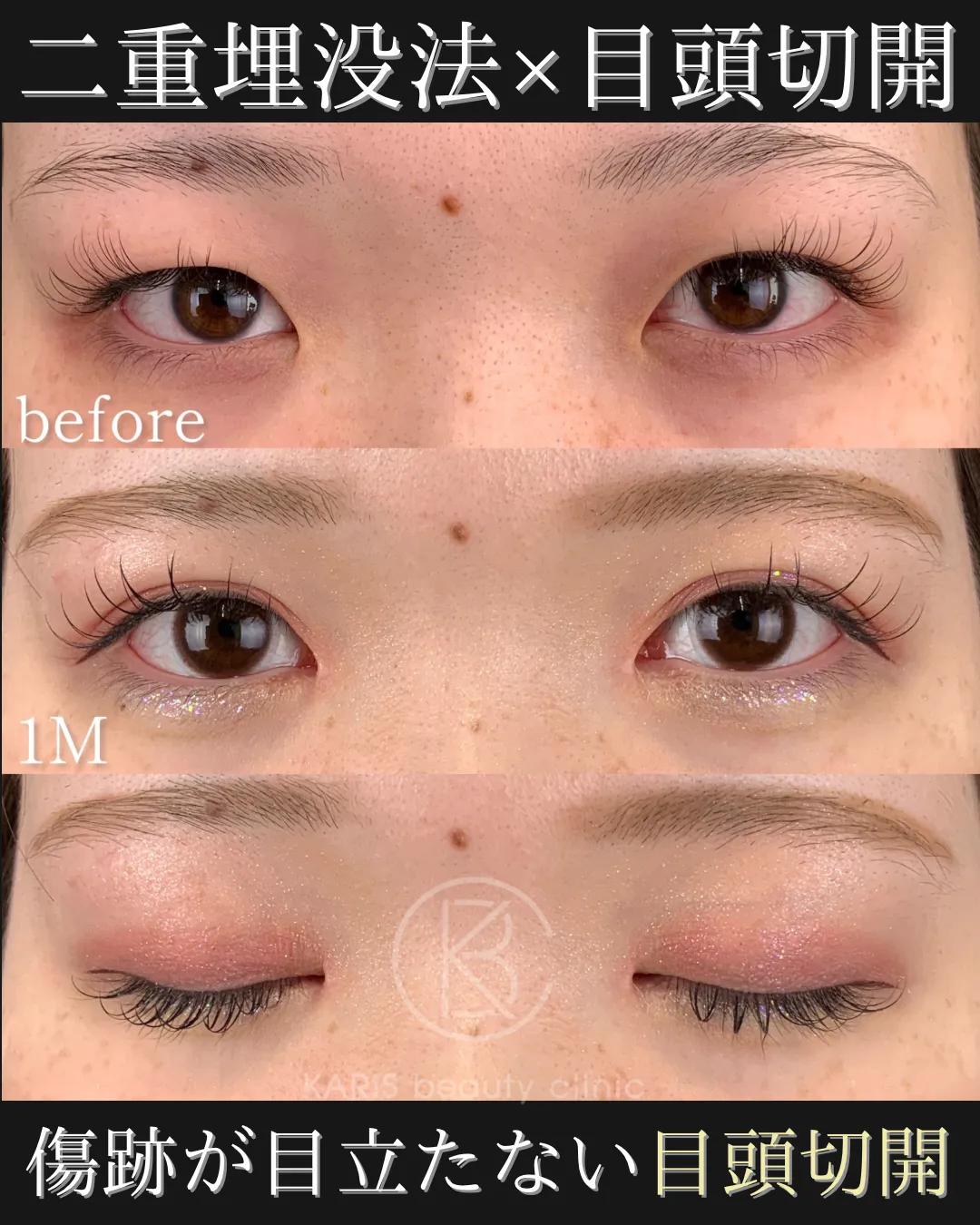 二重埋没クロス法