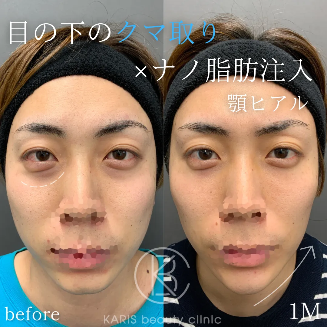 クマ取り +ナノ脂肪注入