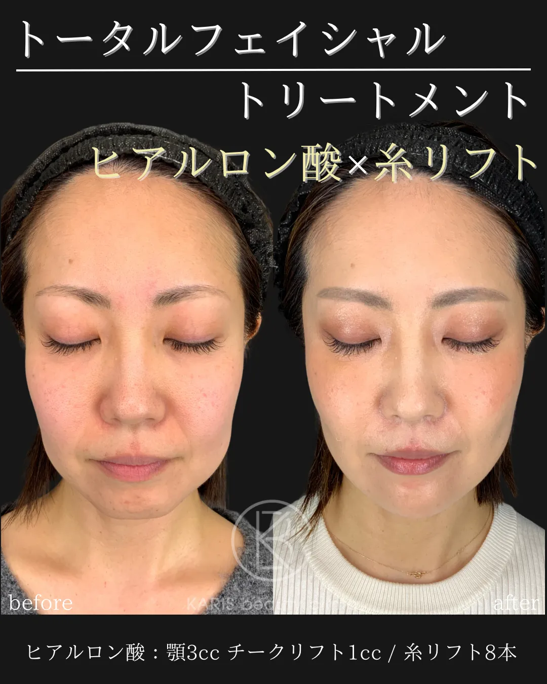 糸リフト
