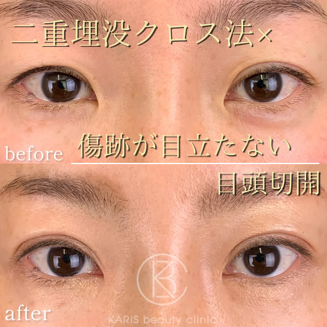 二重埋没クロス法